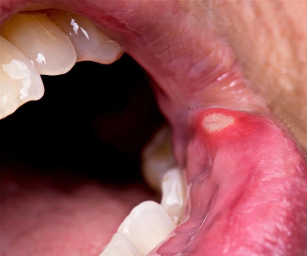 dudakta aft neden çıkar 