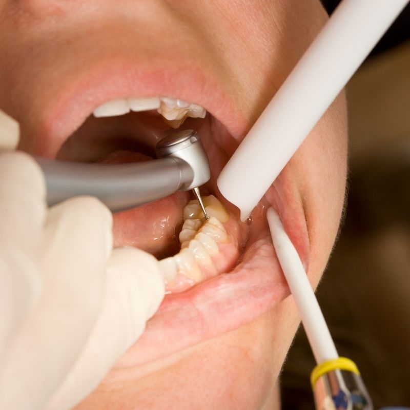 Diş dolgu fiyatları