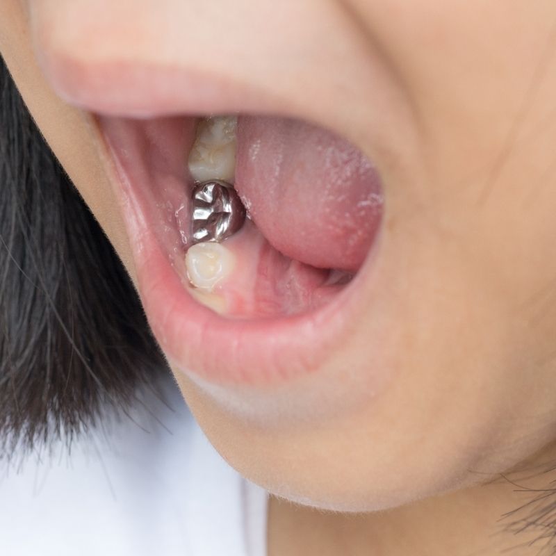 diş dolgusu çeşitleri