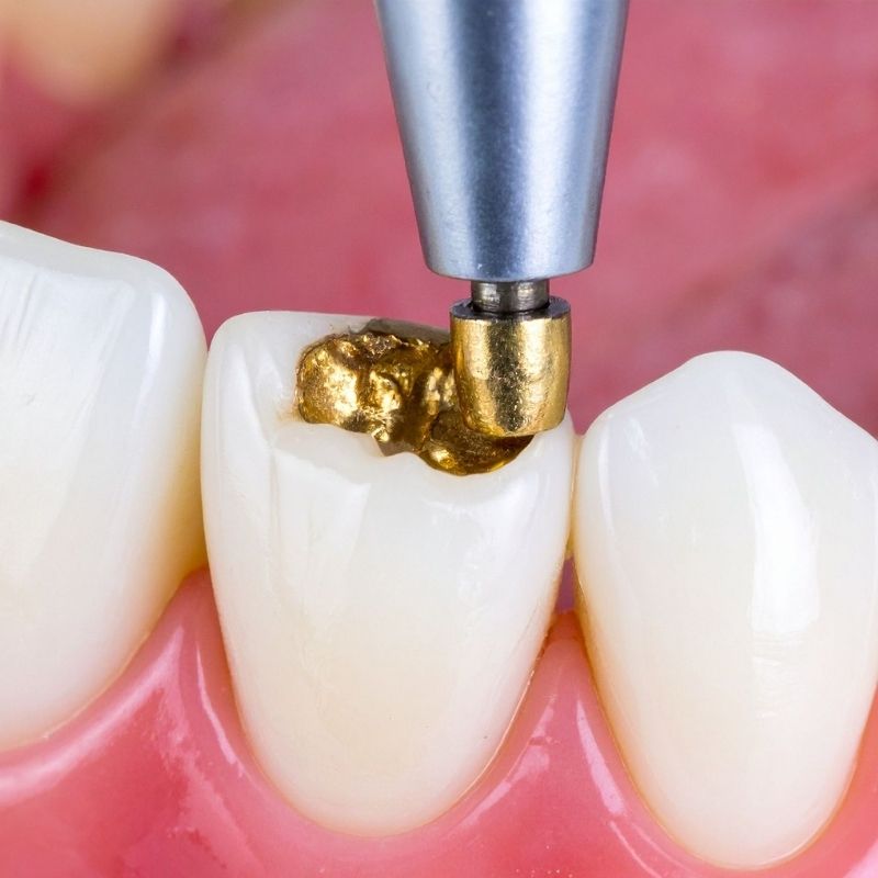 diş dolgusu çeşitleri