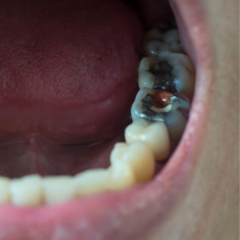 diş dolgusu çeşitleri