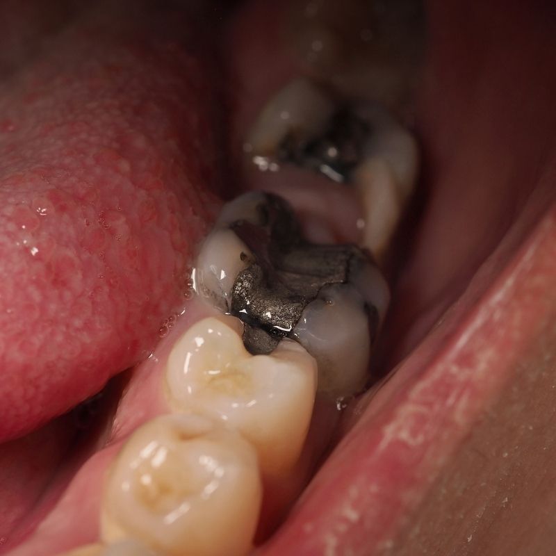 diş dolgusu nasıl yapılır