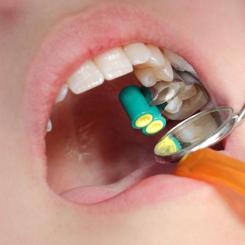 Diş dolgusu nasıl yapılır