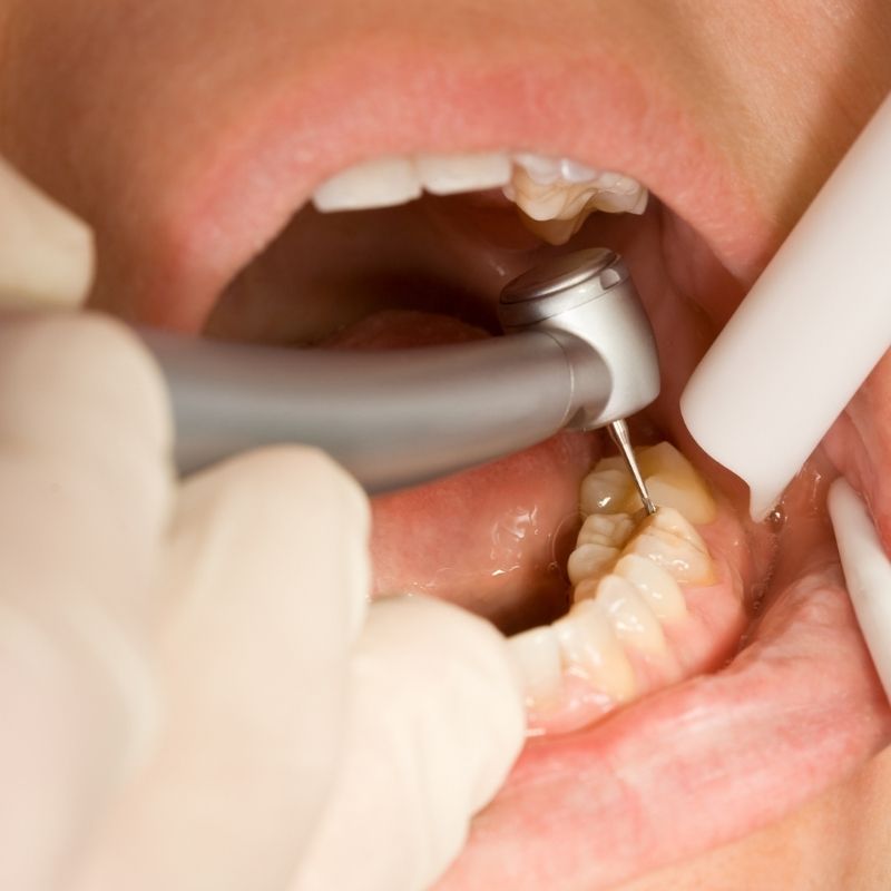 Diş dolgusu nasıl yapılır