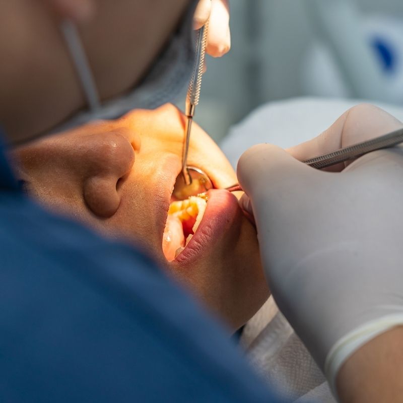 Diş tartarı temizliği