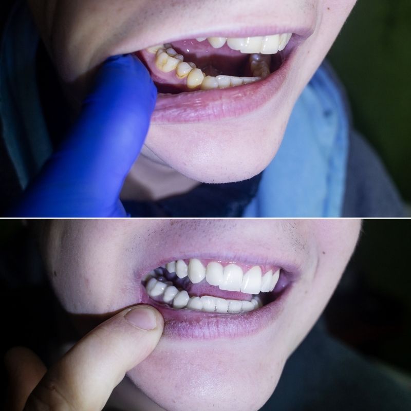 Diş Taşı Temizliği Nasıl Yapılır?