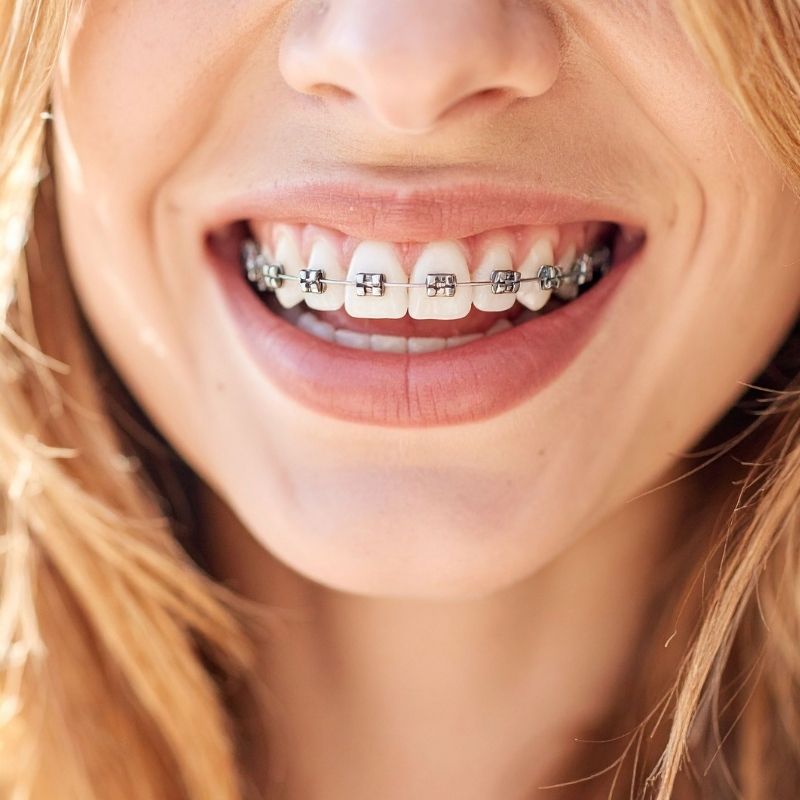 Diş Teli Fiyatları 2026