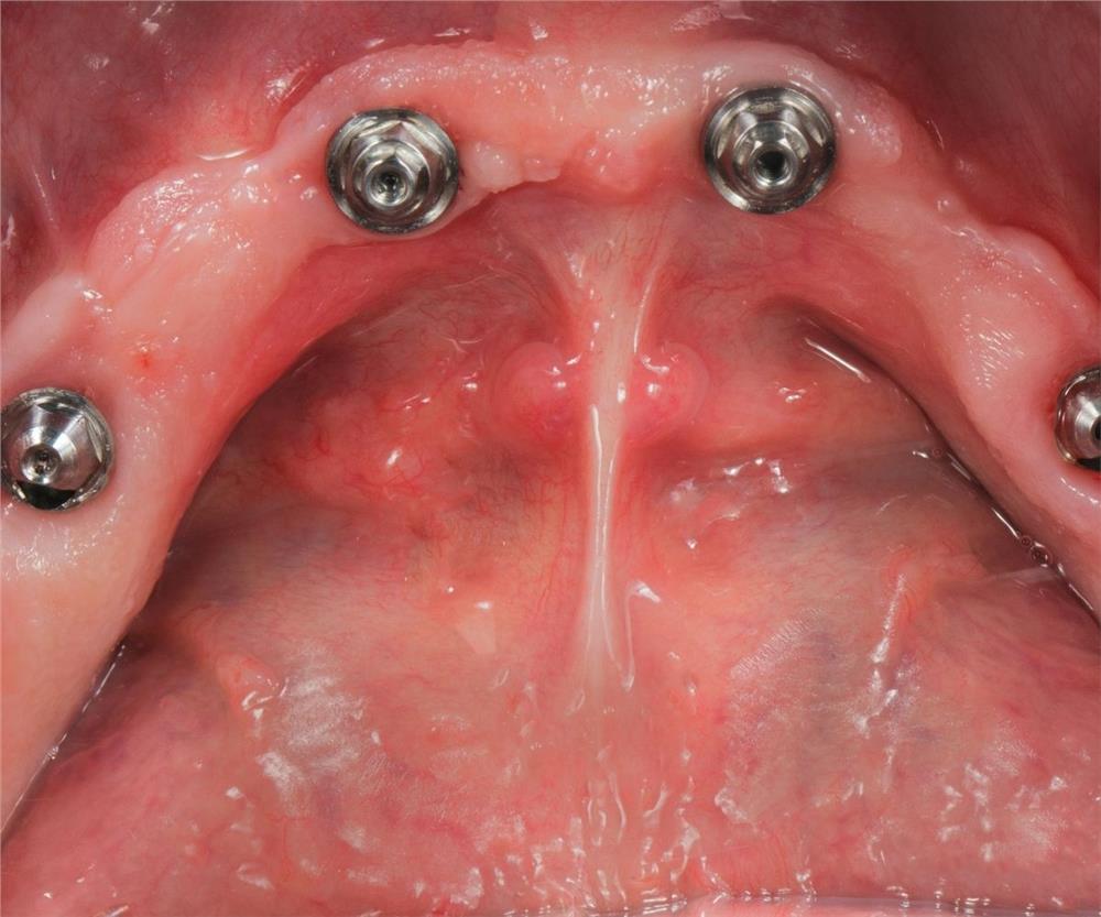 İmplant vidası takılma işlemi