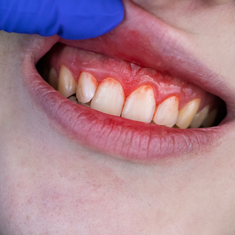 Durduk yere diş eti kanaması neden olur Durduk yere diş eti kanaması neden olur