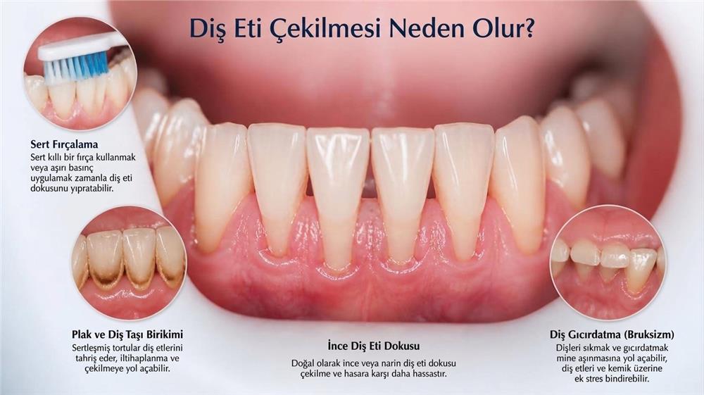 Diş Eti Çekilmesi Neden Olur Diş Eti Çekilmesi Neden Olur