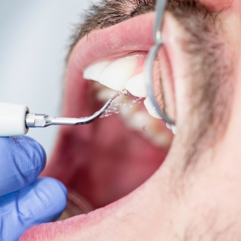 Diş Taşı Temizliği Nasıl Yapılır​