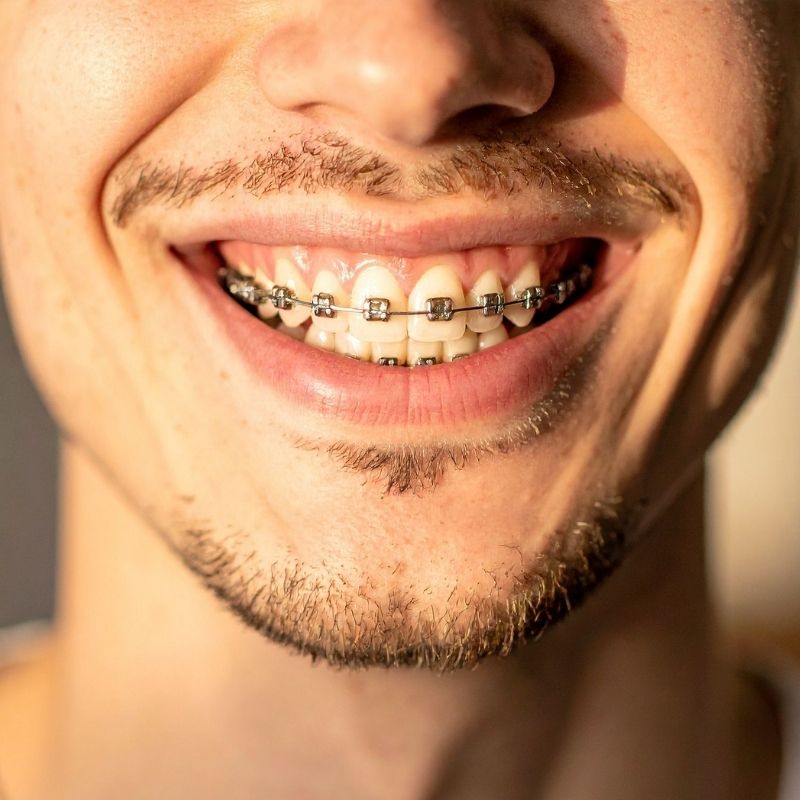 Diş Teli Fiyatları​